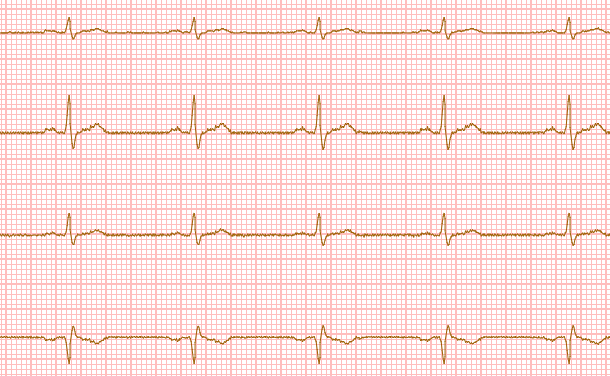 html5-canvas-electrocardiogram